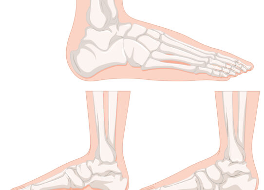 Piede piatto nel bambino e nell'adulto come si cura