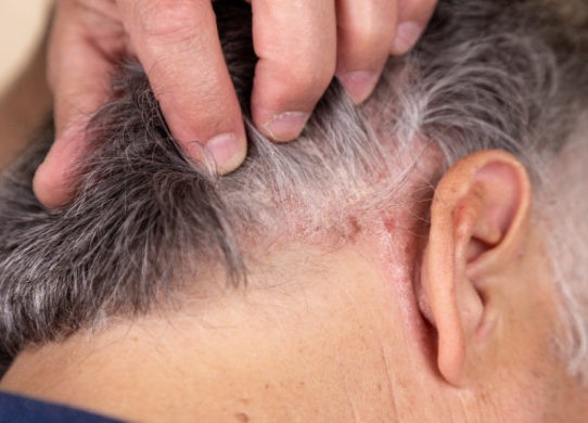 Psoriasi, malattia cronica e ciclica