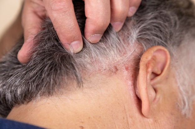 Psoriasi, malattia cronica e ciclica