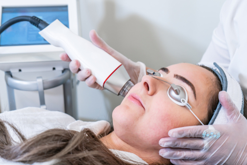 Radiofrequenza viso effetti e benefici