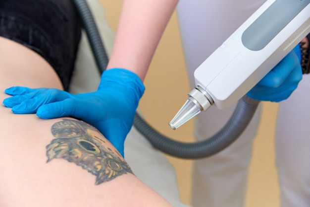 Rimozione di tatuaggi con il laser