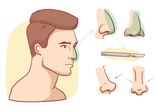 Rinofiller un'alternativa innovativa alla rinoplastica