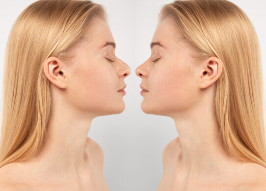 Rinoplastica Vs rinofiller le differenze di questi due trattamenti