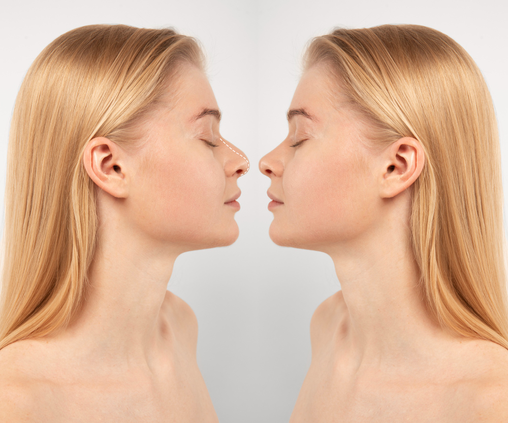Rinoplastica Vs rinofiller: le differenze di questi due trattamenti