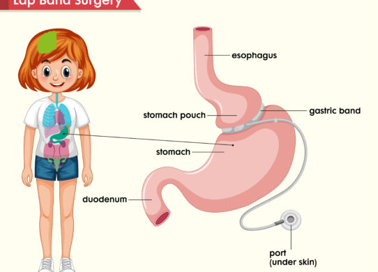 Sleeve Gastrectomy Una soluzione efficace per il trattamento dell'obesità