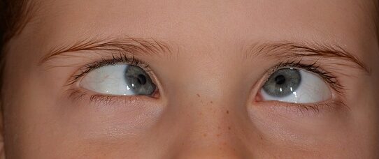 Strabismo congenito forme particolari