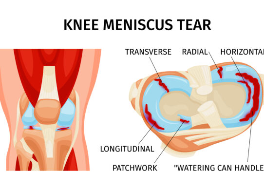 Sutura meniscale: per quali lesioni è una soluzione valida? I menischi del ginocchio sono posti tra femore e tibia. Si tratta di strutture fibrocartilaginee poco vascolarizzate presenti all’interno e all’esterno del ginocchio. Entrambi i menischi servono ad ammortizzare i carichi e gli urti tra le due superfici ossee, oltre a proteggere la cartilagine articolare. Nella meccanica del ginocchio, i menischi svolgono dunque il ruolo essenziale di ridurre il carico delle superfici articolari, assorbendo circa il 50% del carico in estensione e l’80% del carico quando il ginocchio è flesso a 90°. Diminuiscono l'attrito tra le superfici articolari femoro-tibiali e aumentano la stabilità del ginocchio. Inoltre, il menisco agisce da struttura propriocettiva (cioè capace di percepire e riconoscere la posizione del corpo nello spazio e lo stato di contrazione dei muscoli). Cosa fare quando il menisco si rompe? Quando il menisco subisce una rottura perde le capacità sopra descritte, subentrano il dolore e l’impotenza funzionale che portano ad un trattamento chirurgico. E’ possibile sottoporsi a meniscectomia parziale o totale oppure a sutura meniscale. La meniscectomia parziale o totale da un lato temporaneamente risolve i sintomi, dall’altro rende l’articolazione instabile aumentando le forze di carico sulle superfici articolari. Per tale motivo, la tendenza del chirurgo ortopedico è cercare di recuperare il menisco suturandolo. La sutura meniscale non è però indicata in tutti i casi. Meniscectomia o sutura meniscale? La sutura meniscale dovrebbe essere considerata la prima scelta per gli sportivi, dal momento che hanno una richiesta funzionale maggiore e necessitano di una buona stabilità articolare. La preferenza del trattamento, però, può dipendere dalla capacità del chirurgo, ma soprattutto dal tipo di lesione. Secondo la classificazione di Arnoczky le lesioni meniscali sono localizzate in tre zone differenti: la zona rossa (3 mm dalla giunzione menisco-capsulare), la zona rossa-bianca (tra 3 e 5 mm dalla giunzione) e la zona bianca (oltre 5 mm dalla giunzione). L’indicazione corretta per la sutura meniscale è la presenza di una lesione longitudinale, non complessa e situata nelle zone rossa o rossa-bianca (le più vascolarizzate). Come avviene la sutura meniscale? La sutura meniscale si avvale di una tecnica tipo all-inside (tutta eseguita dall’interno dell’articolazione per via artroscopica) con strumentario dedicato. Il primo step prevede la misurazione di dimensione e profondità della lesione, dopo di che si inserisce una piccola ancora nello spessore meniscale sul versante capsulare 5 mm al di sopra della lesione, dalla quale fuoriescono due fili non riassorbibili. Si arretra l’introduttore e sullo stesso sistema di fili si inserisce una seconda ancoretta, 5 mm al di sotto della lesione, attraversando questa volta il margine libero del menisco. Mettendo in tensione i fili, le due porzioni di menisco verranno a stretto contatto tra loro e si provvederà dunque a completare la sutura con un nodo. Risultato e recupero dopo una sutura meniscale L’apporto di sangue nella parte periferica del menisco è fondamentale per attivare il processo di guarigione e riparazione. Non a caso la sutura meniscale è indicata nelle zone del menisco più vascolarizzate. L’intervento di sutura, se ha buon fine, consente di ripristinare in modo quasi totale la funzionalità dell’articolazione interessata. E’ necessario, però, che vi siano ottime probabilità che la lesione si rimargini, altrimenti c’è il rischio concreto che il paziente debba essere sottoposto in seguito ad un ulteriore intervento per la sua rimozione. E’ per questa ragione che la sutura ha maggior successo in pazienti più giovani, proprio perché il loro potenziale rigenerativo di solito è elevato. L’unico aspetto negativo della sutura meniscale è rappresentato dai tempi di recupero più lunghi rispetto alla meniscectomia. Si dovrà, infatti, camminare con l’ausilio di una ginocchiera che impedisca la flessione per 20 giorni e non si dovrà caricare per 30 giorni. Se però la scelta è stata corretta e l’intervento è stato eseguito correttamente, il risultato finale farà senz’altro dimenticare in fretta i 20-30 giorni di limitazione nei movimenti. Foto