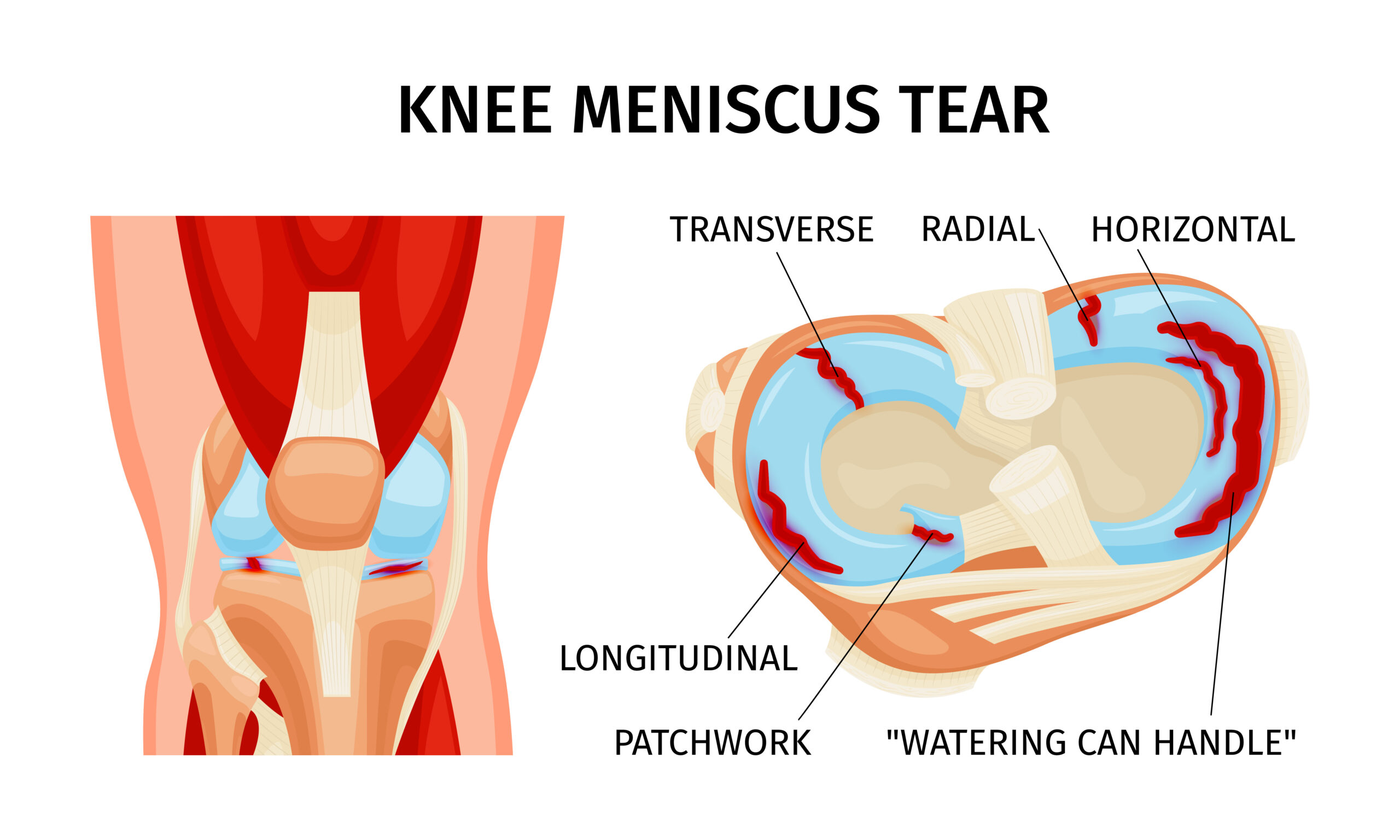 Sutura meniscale: per quali lesioni è una soluzione valida?