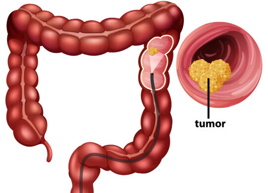 Trattamento Laparoscopico del Tumore Intestinale Innovazioni e Vantaggi