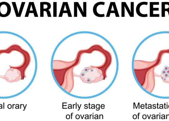Tumore ovarico malignonuove tecniche operatorie (robotica) e nuove prospettive chemioterapiche