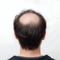 Alopecia Androgenetica