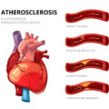 atherosclerosis
