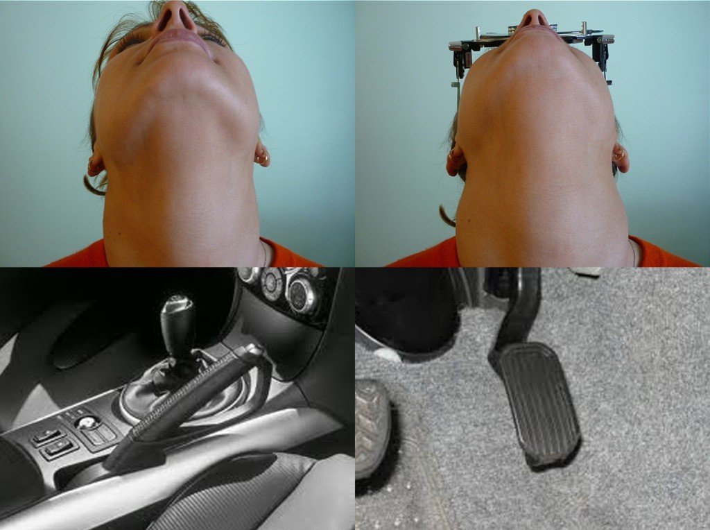 Fig 2 Le cervicali sono bloccate, è come avere il freno a mano tirato invece che andare con un filo di gas