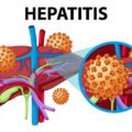 epatite