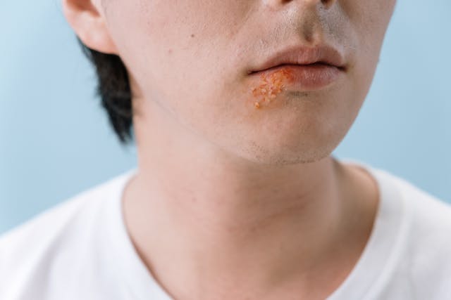 Si può curare l’herpes labiale senza farmaci?