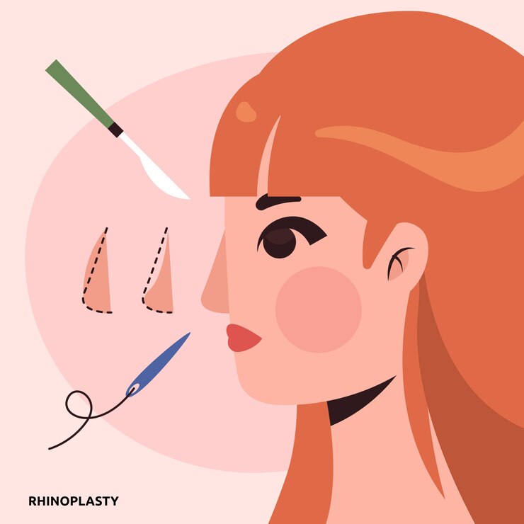 Rinoplastica Secondaria