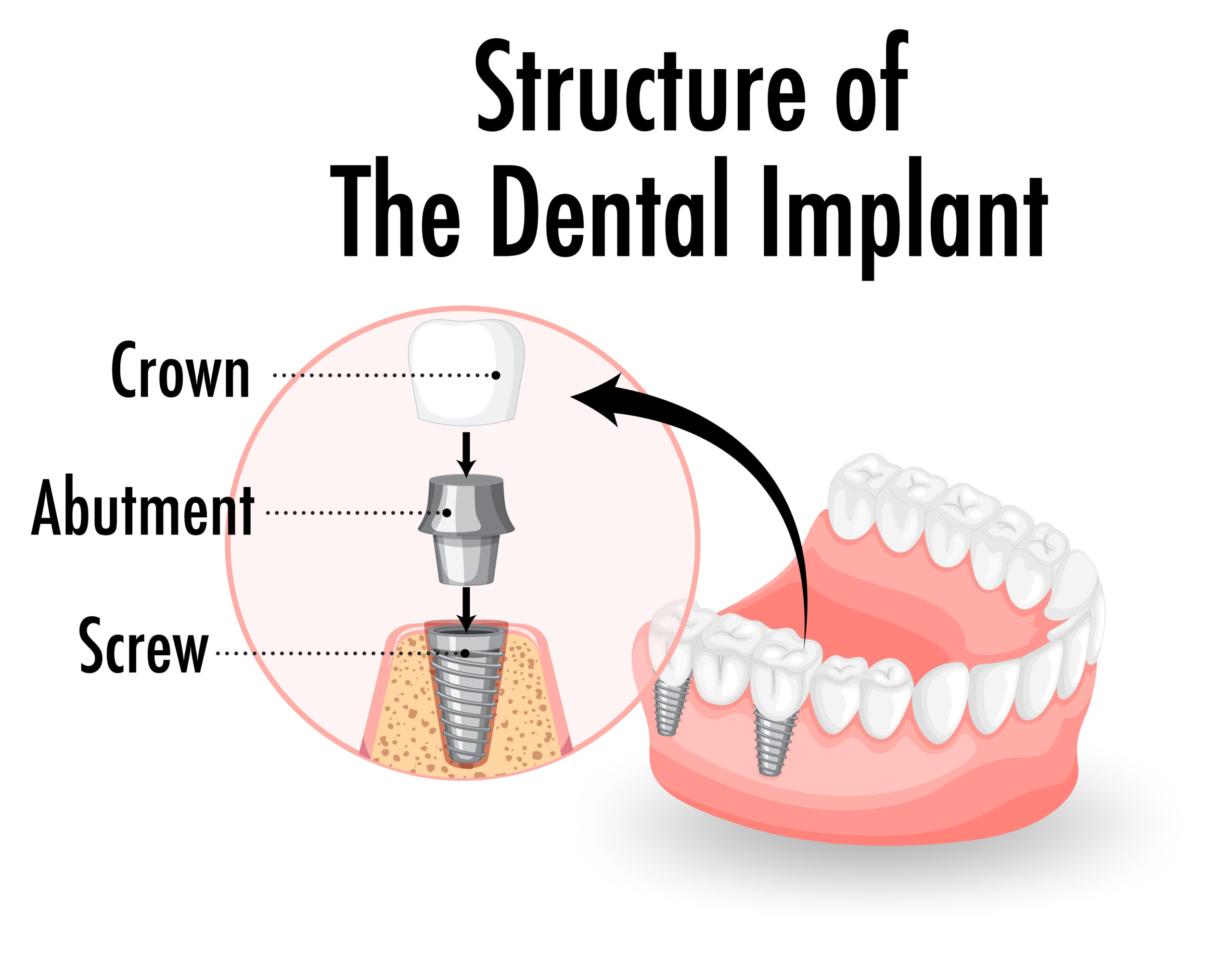 Impianti Osseointegrati Branemark: Innovazione in Odontoiatria