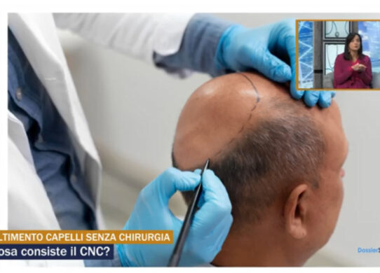infoltimento capelli