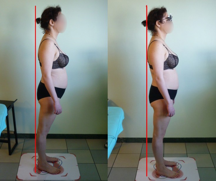 Fig 3 la iperlordosi richiede un enorme sforzo