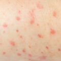 morbillo
