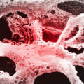 osteoporosi