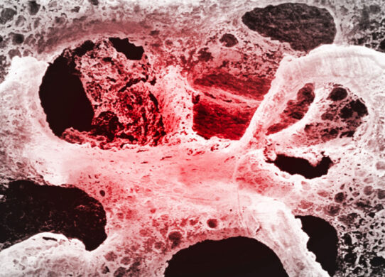 osteoporosi