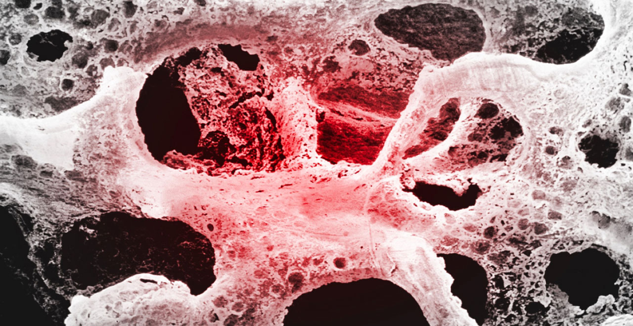 osteoporosi