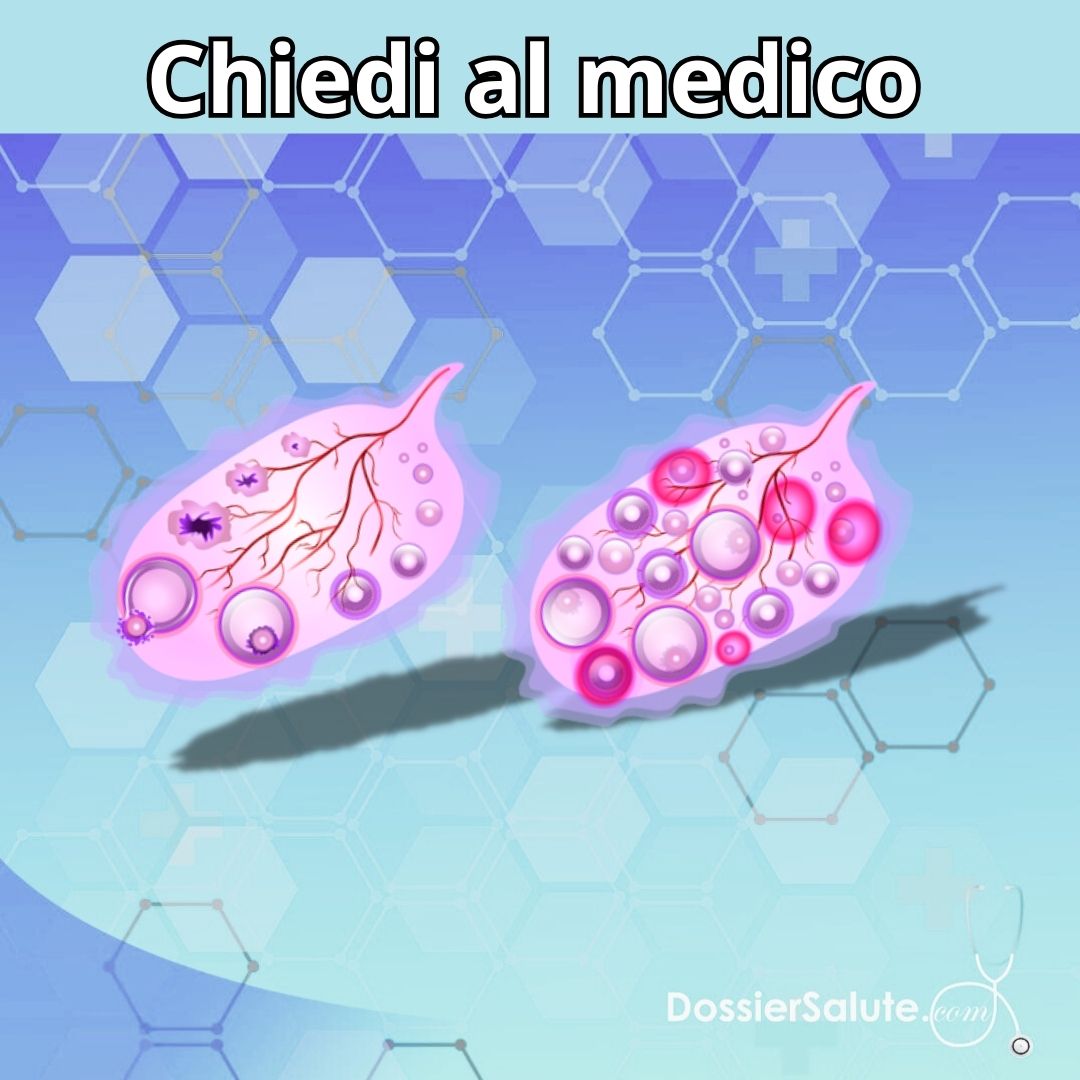 Sindrome dell’Ovaio Policistico (PCOS): è sempre una causa di infertilità?