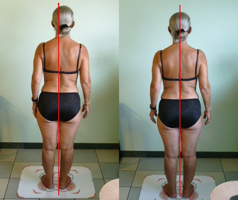 Fig 4 anche a 60 anni ci può essere un immediato recupero