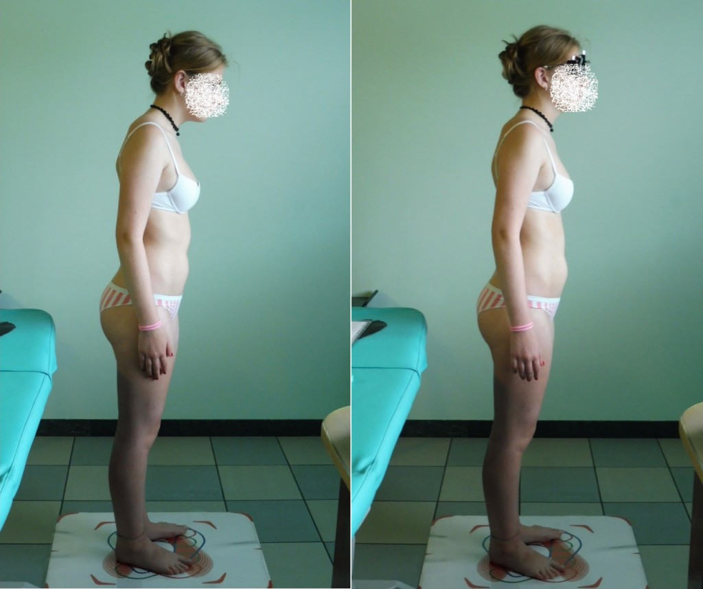 Fig 1 una postura così avanzata è faticosissima e già nelle adolescenti si puà intervenire