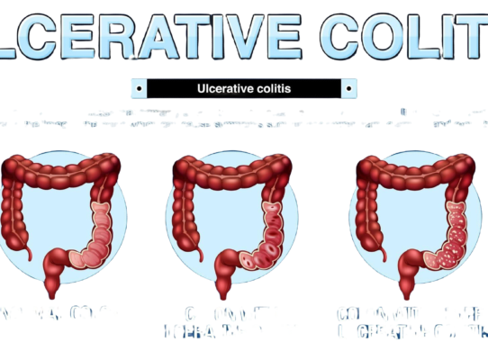colite ulcerosa