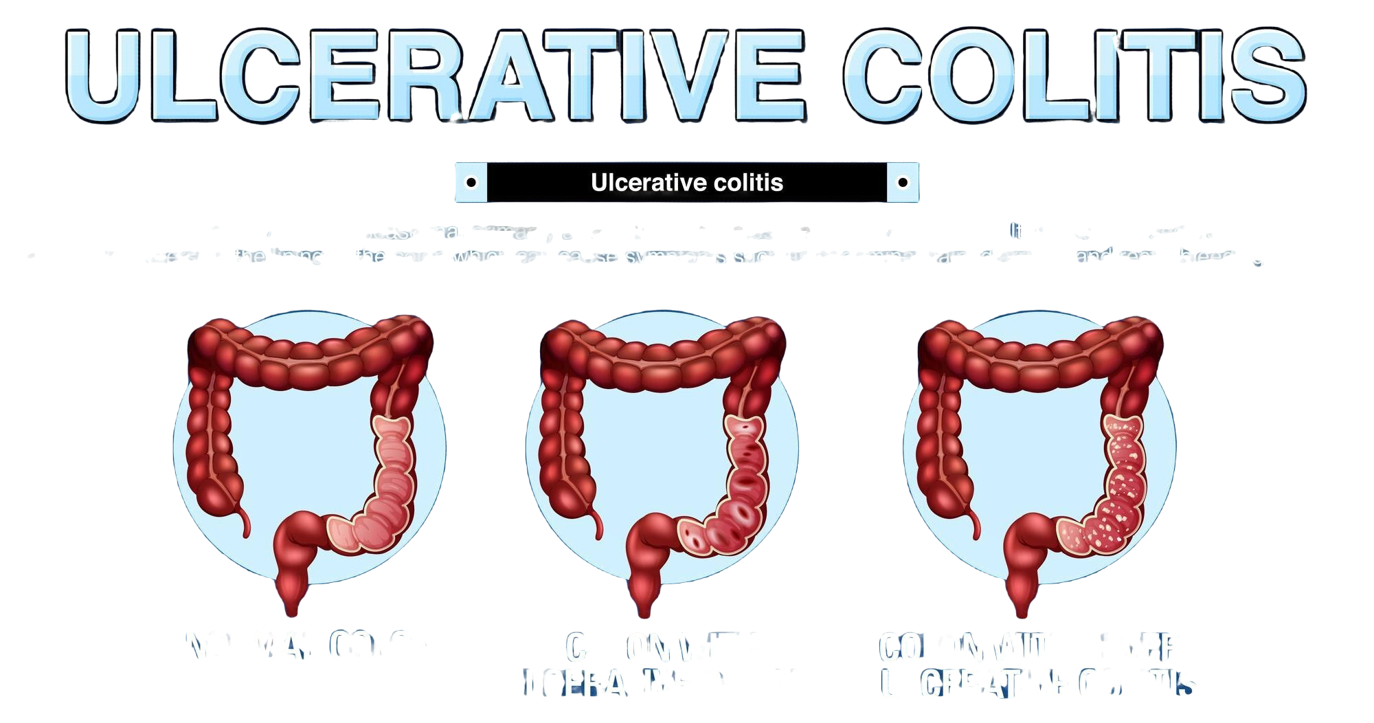 Trattamento delle patologie infiammatorie croniche del colon: colite ulcerosa e Morbo di Crohn