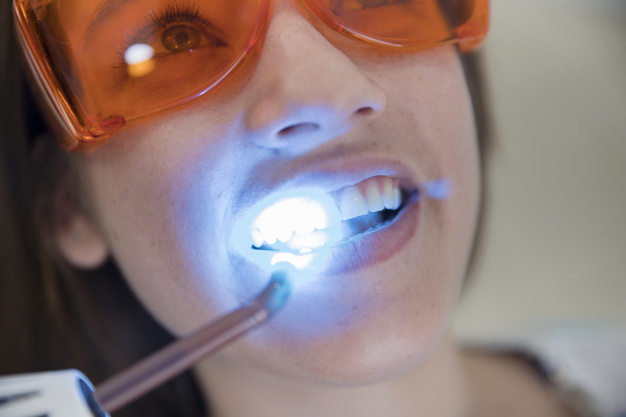 Sbiancamento dei denti: tutto ciò che c’è da sapere