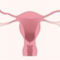 endometriosi